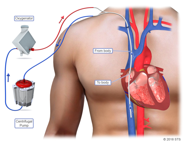 vv-ecmo-the-patient-guide-to-heart-lung-and-esophageal-surgery